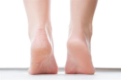 Reveal Soft, Smooth Feet with Changing Foot Peeling Shoes